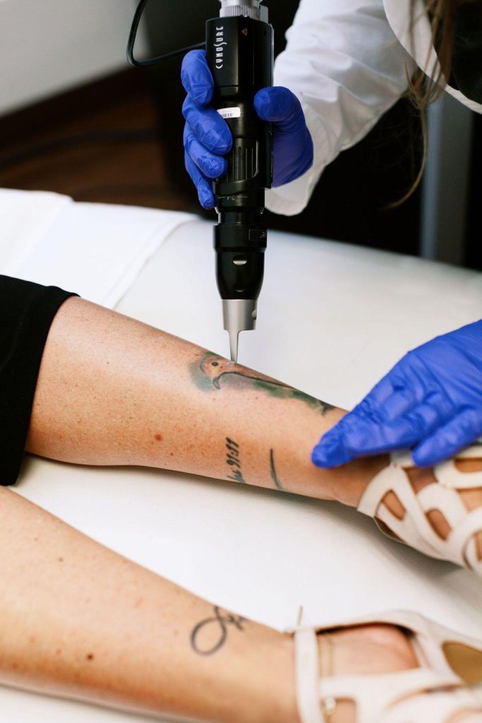 oneill laser tattoo removal procedure 01